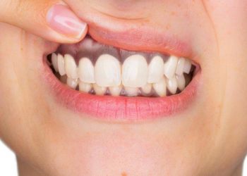 Ketahui Penyebab Gusi Hitam dan Cara Mengatasinya