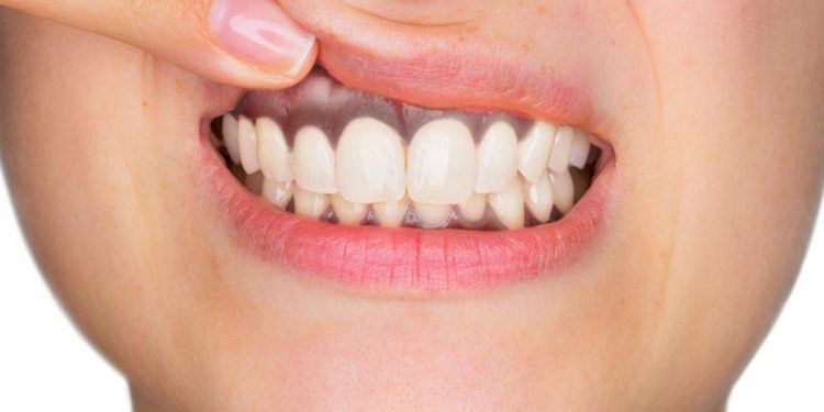 Ketahui Penyebab Gusi Hitam dan Cara Mengatasinya