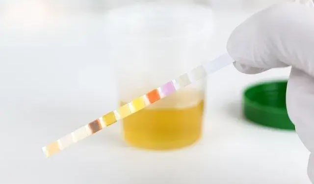 Memahami Keton Urine: Penanda Penting Metabolisme Tubuh